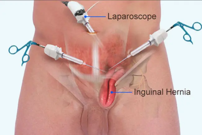 Laparoscopic Hernia Repair