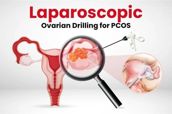 Laparoscopic Ovarian Drilling