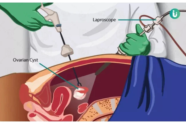 laproscopic ovarian cyst